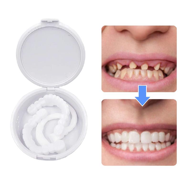 Artificial dental veneers 