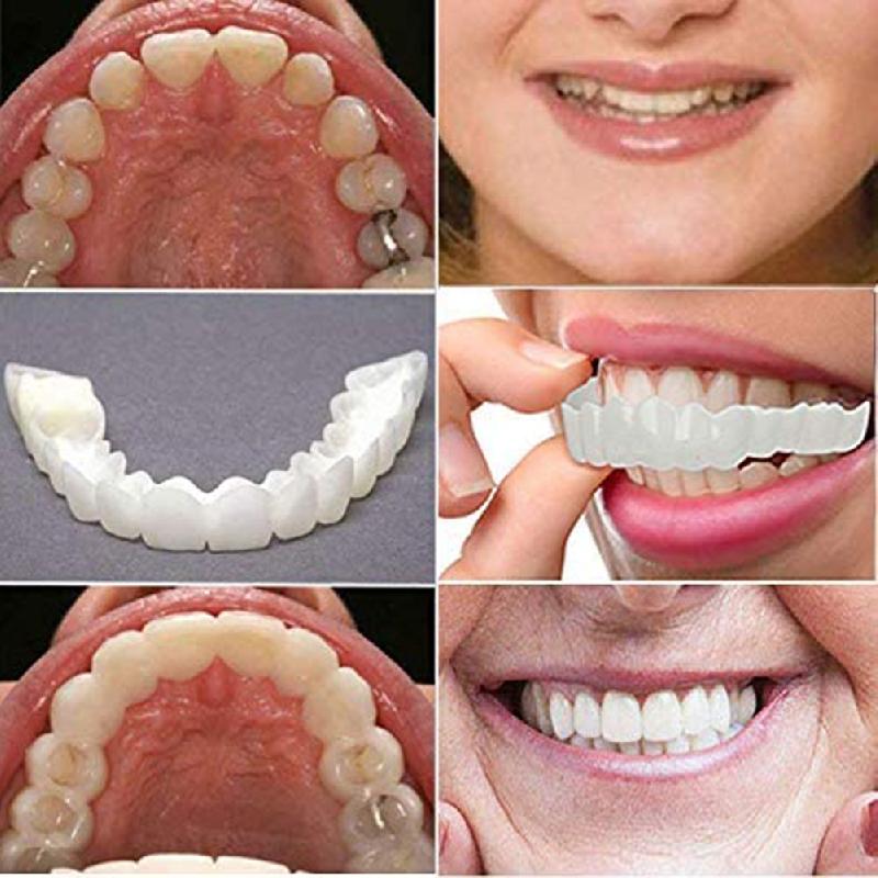 Artificial dental veneers 